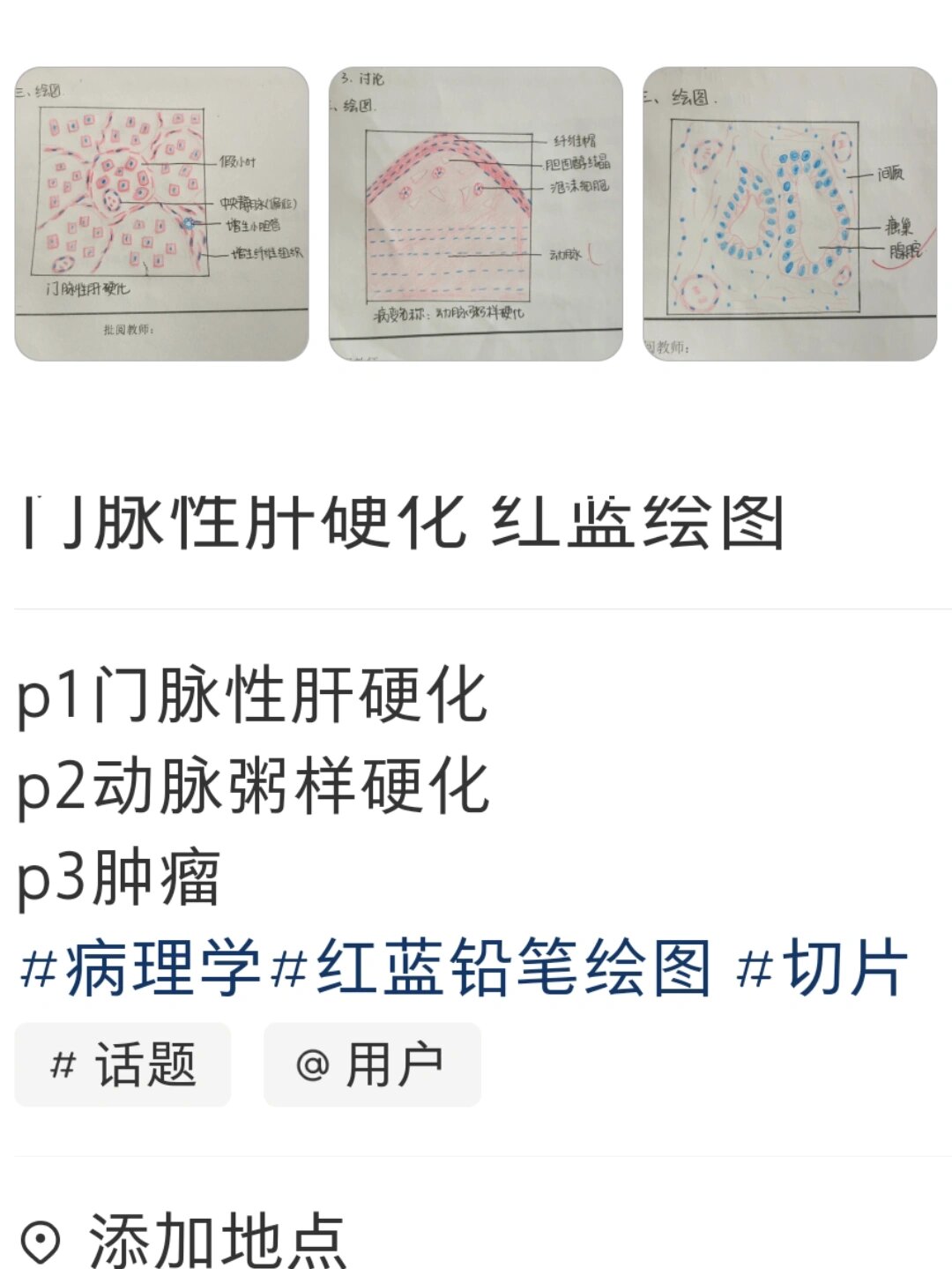 门脉性肝硬化 红蓝图片