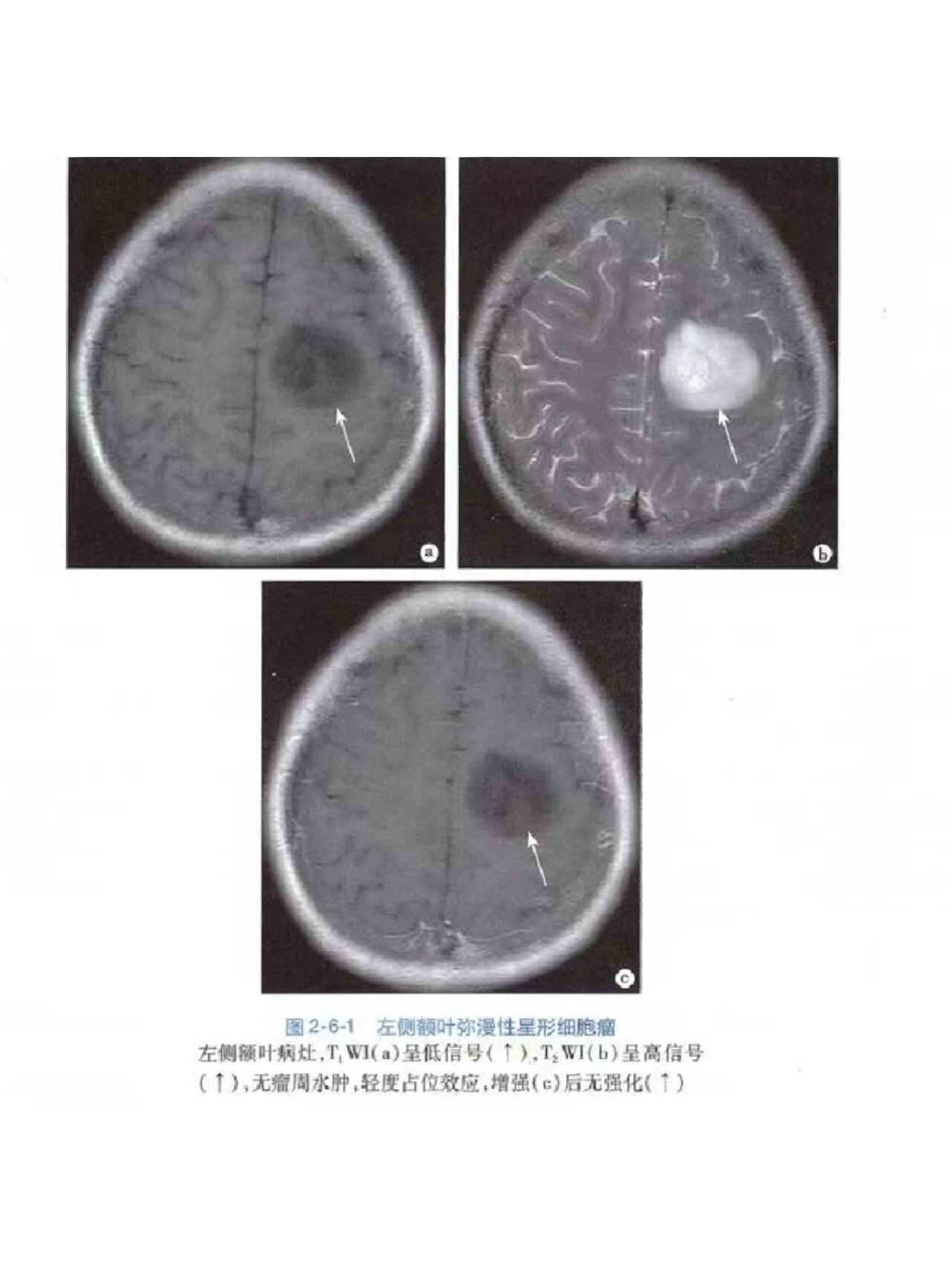 小脑蚓部ct断层图片图片