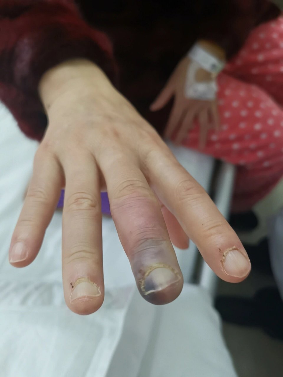 我的病人双手雷诺现象多年(图1-3),遇冷变白变红,变紫,这可能是自身