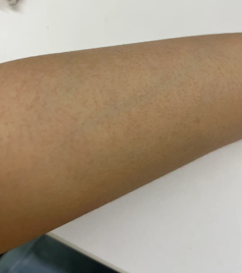 手臂经常暴露在阳光下,紫外线会刺激黑色素细胞过度活跃,产生过多黑