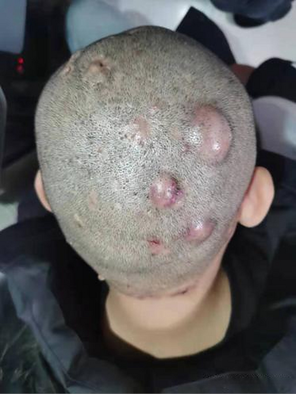 今天发来复诊照片的一位毛囊炎患者,男22岁,大学生.