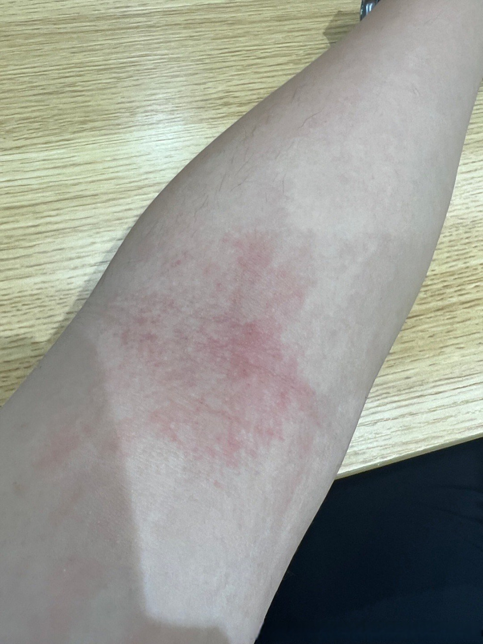 两侧手臂肘窝红色疹子 略微发痒 一抓更严重,您好 这种是过敏吗?