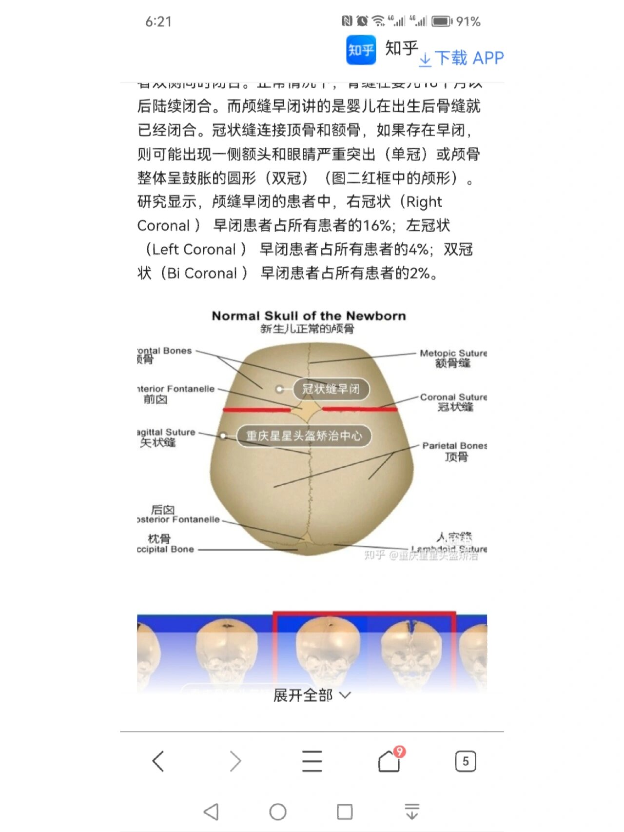 矢状缝跟冠状缝图解