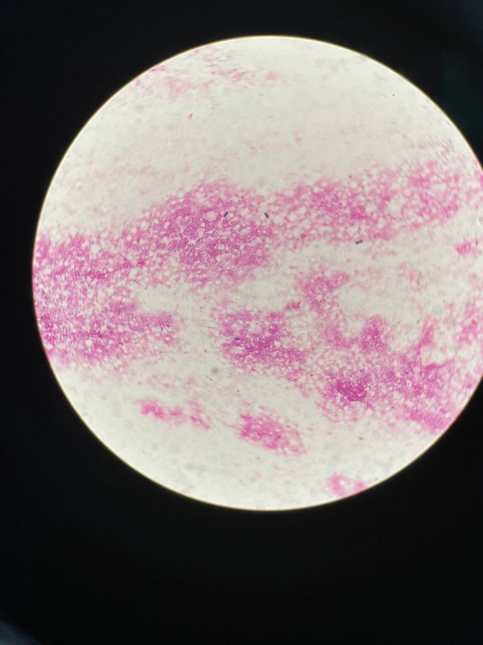 细菌—产气荚膜梭菌 分享一例产气荚膜梭菌 p1-3标本直接涂片革兰染色