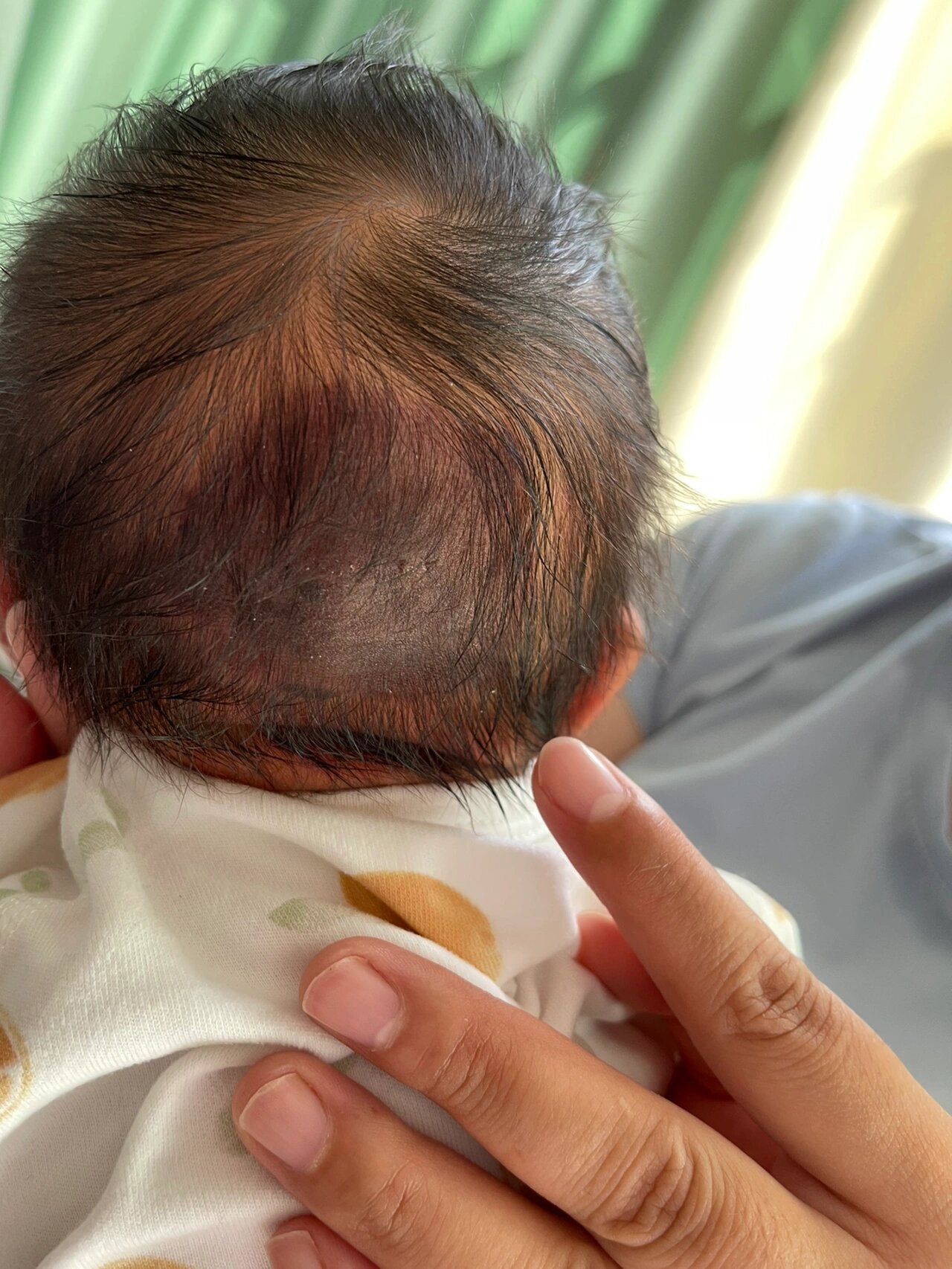 新生儿后脑勺深黑色