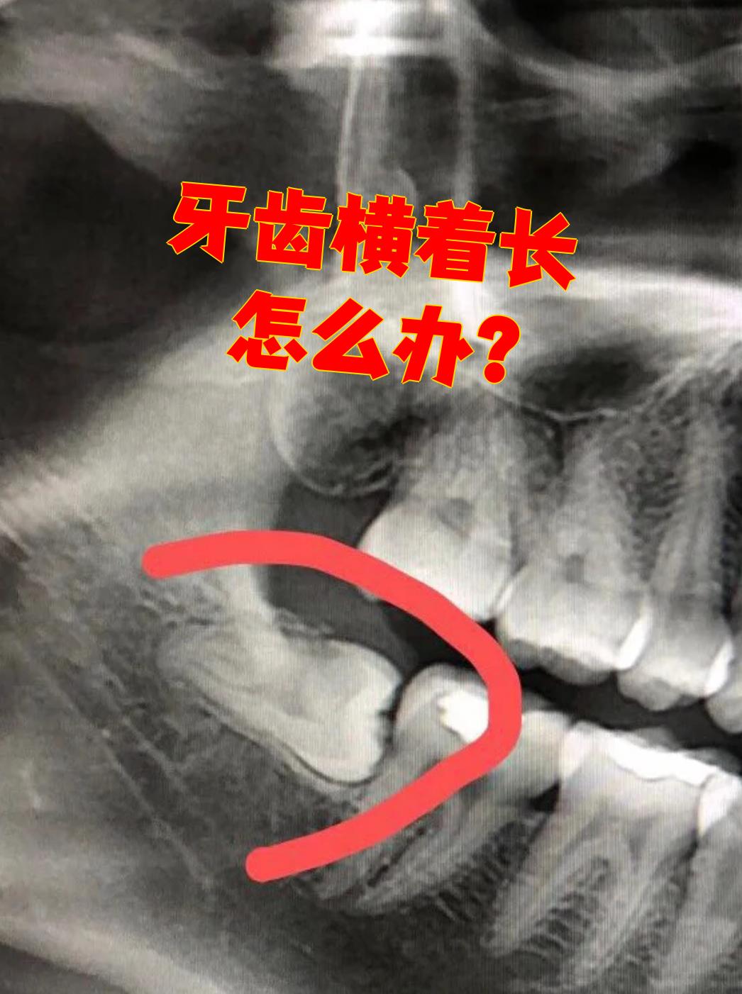 牙齿横着长需要看具体是哪颗牙,常见的有智齿,多生牙和正常恒牙戎种