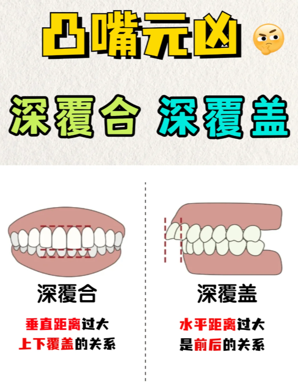 深覆盖和深覆合图解图片