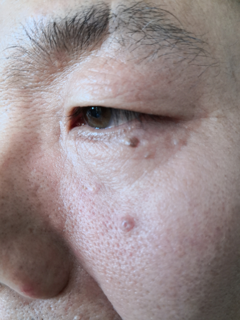 面颊眼下方黑褐色斑块和淡白色丘疹.