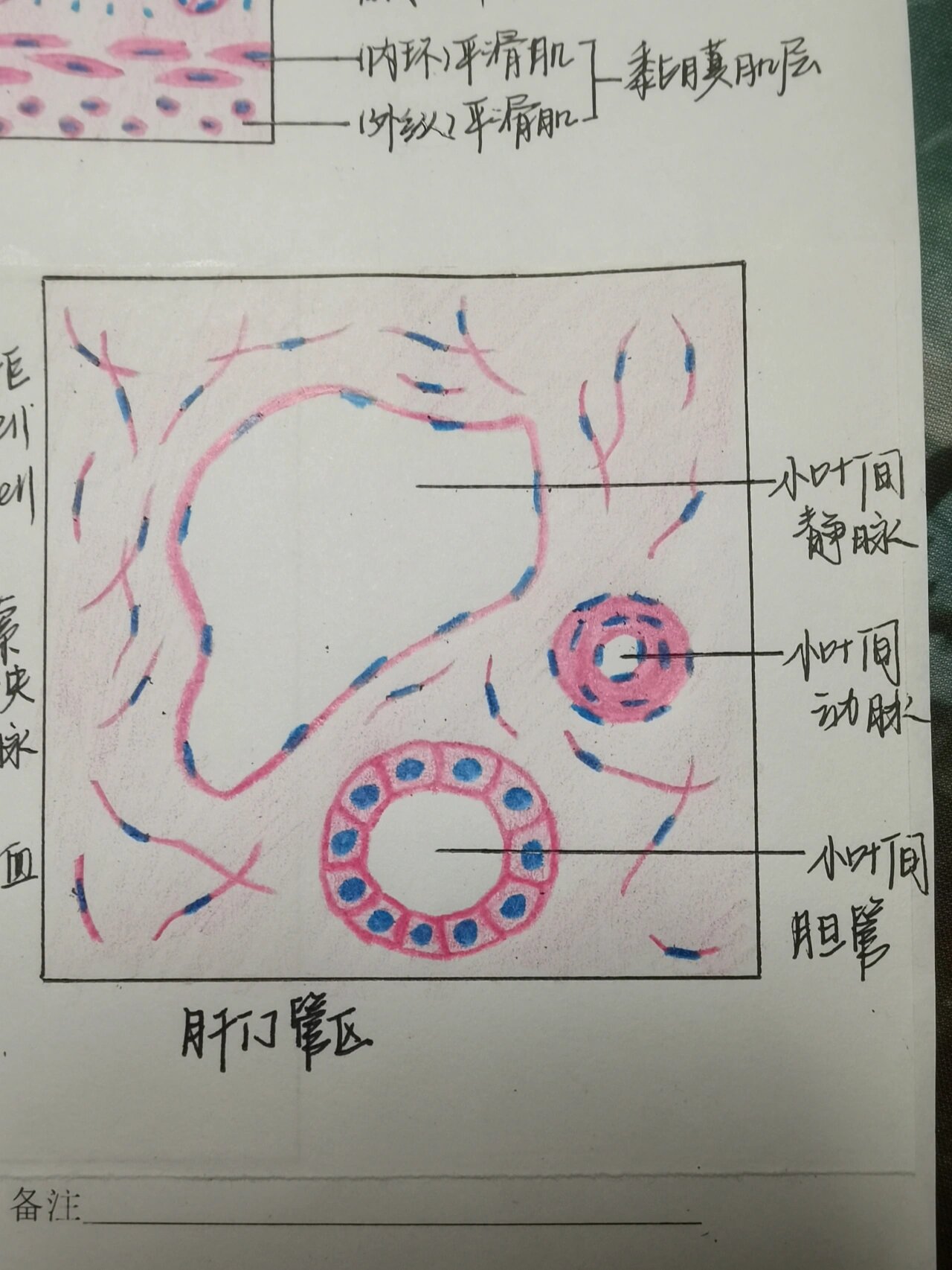 肝硬化假小叶手绘图图片