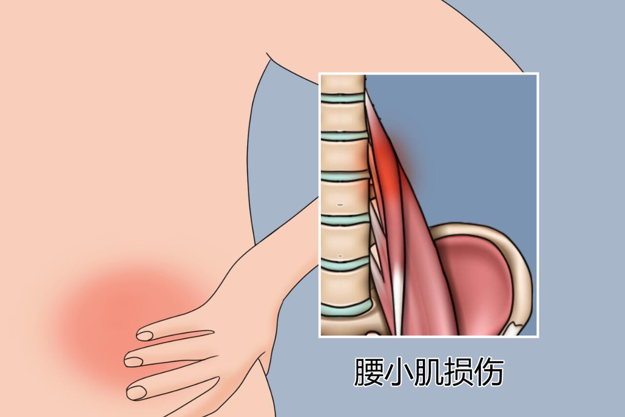 腰肌劳损疼痛的部位图片