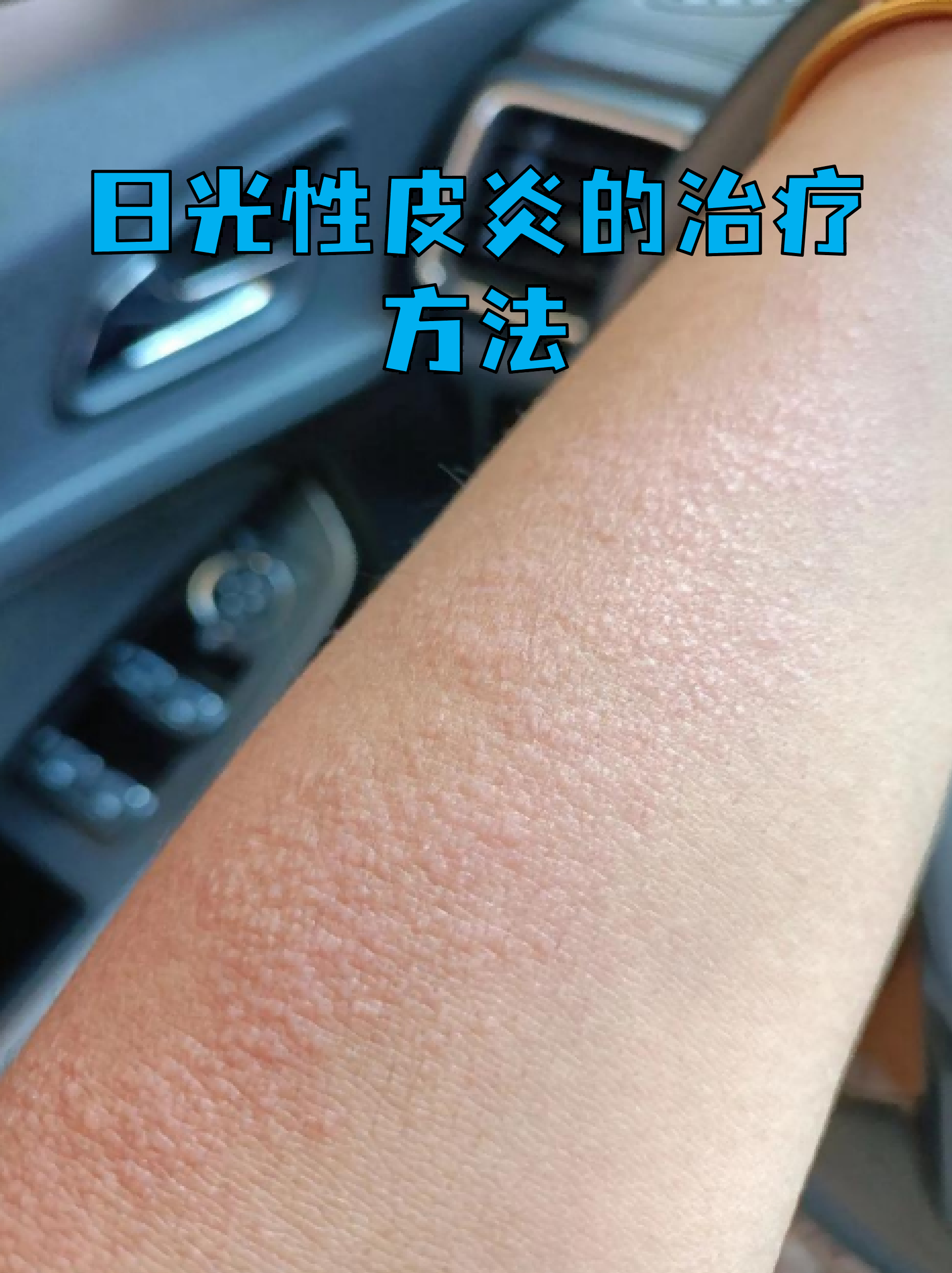 日光性皮炎的治疗方法