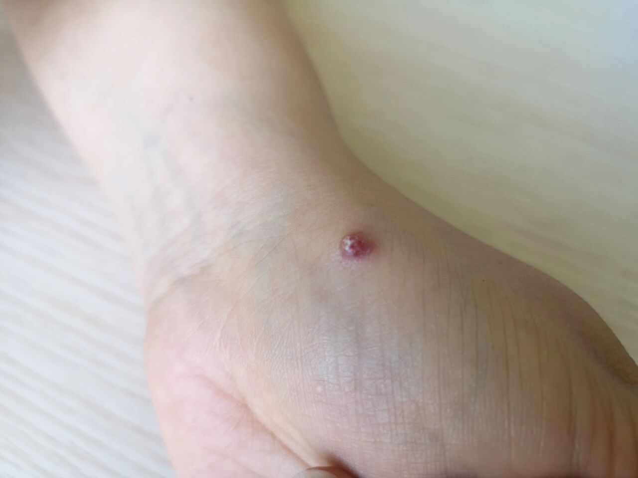 手上突然出现血管瘤一样的东西,要紧吗