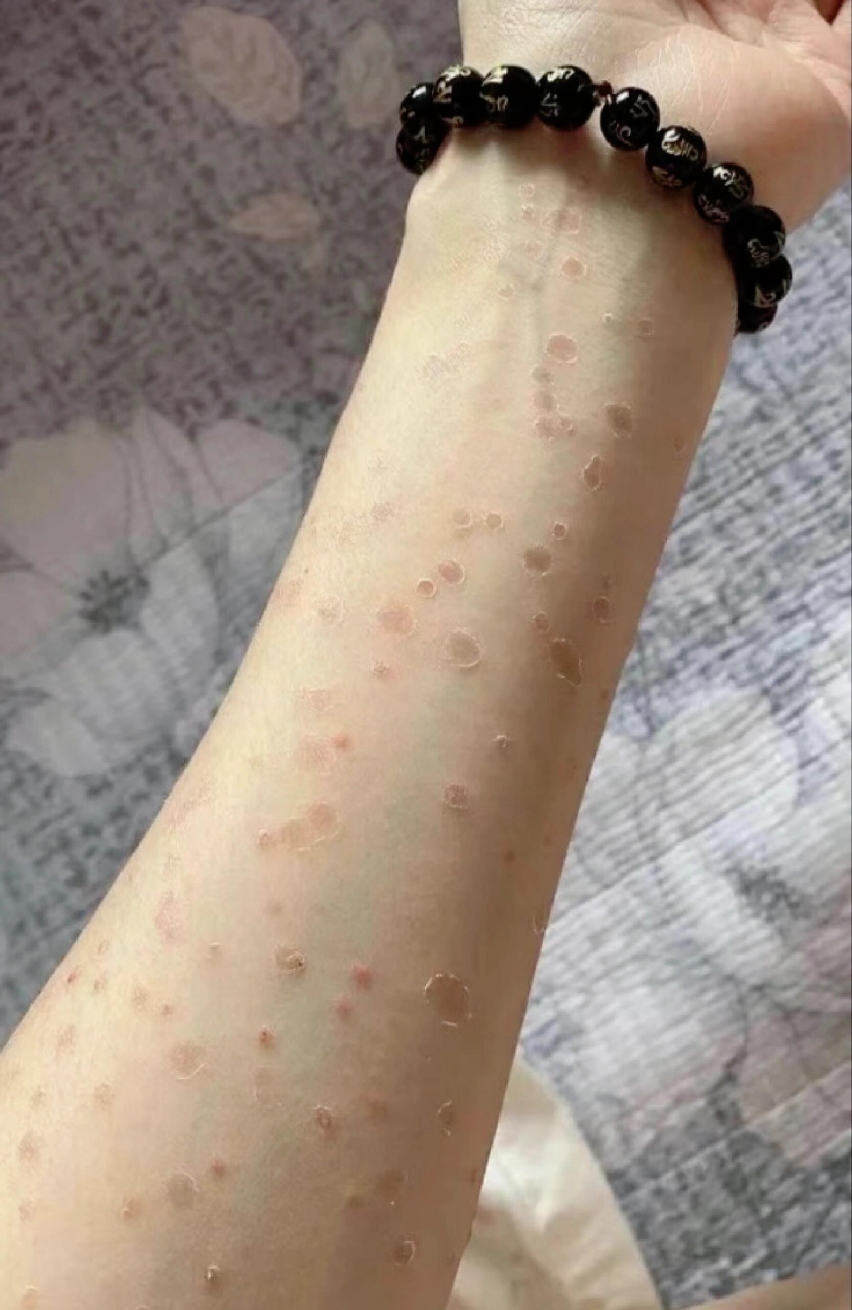 银屑病好了,不痒了,告白这个折磨的银屑病