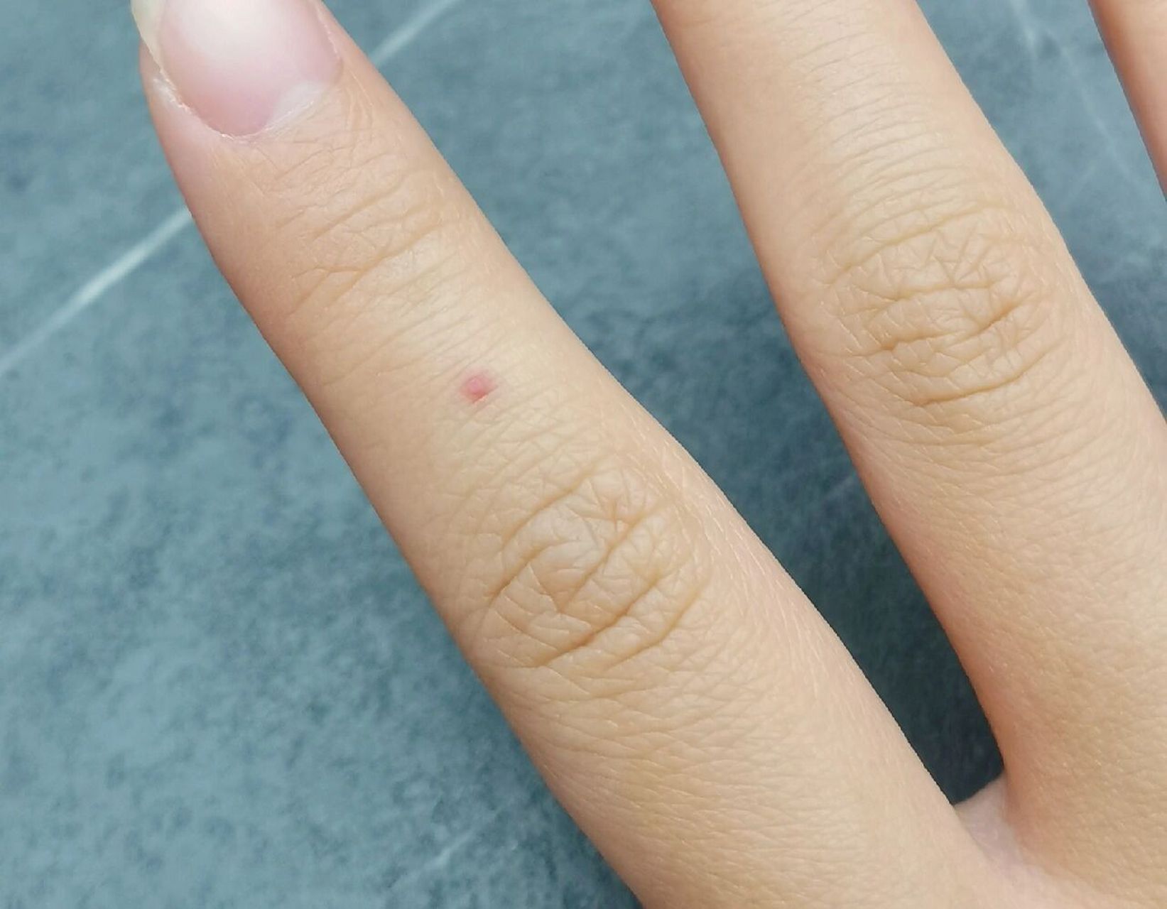 手上的小红点是什么呢?