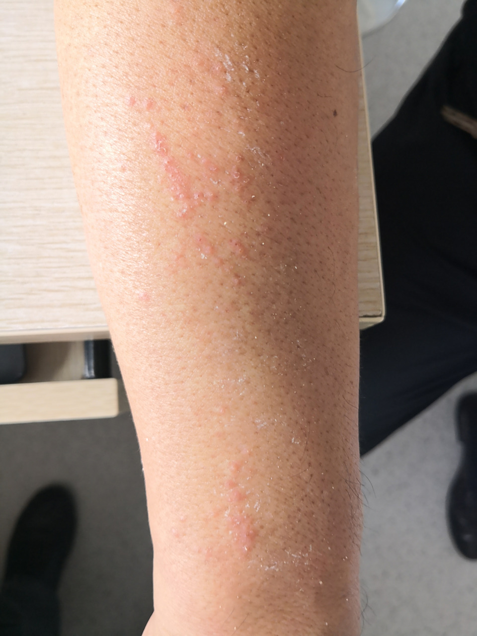 考虑夏季皮炎症状#解决皮肤问题专注皮肤美容##过敏