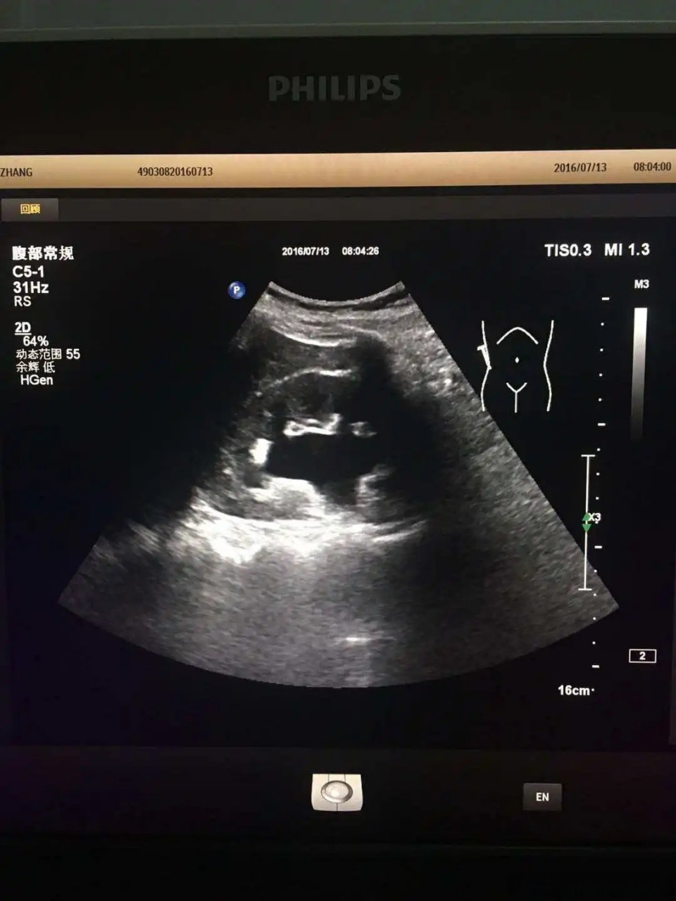 中医外治疗法调理肾积水效果良好  "肾积水"是由泌尿系统的梗阻,导致