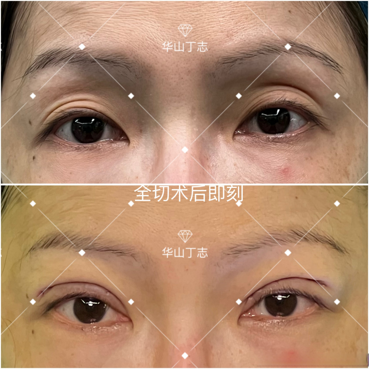 案例展示:术前眼窝严重凹陷,术中将眶隔内残余脂肪形成瓣,转移至凹陷