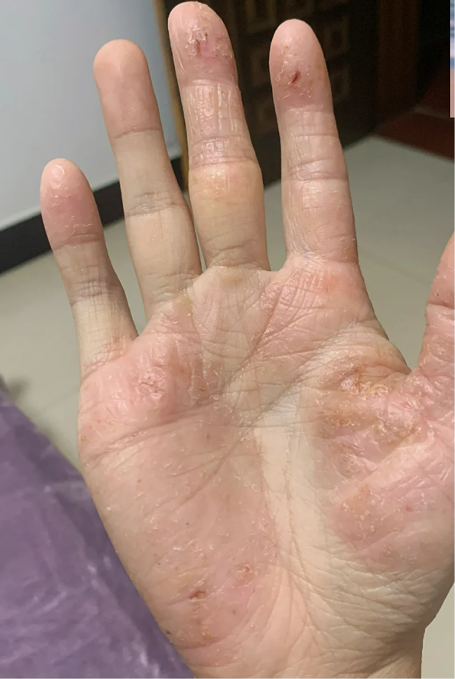 鹅掌风也叫手癣,是真菌感染引起的手部皮肤病