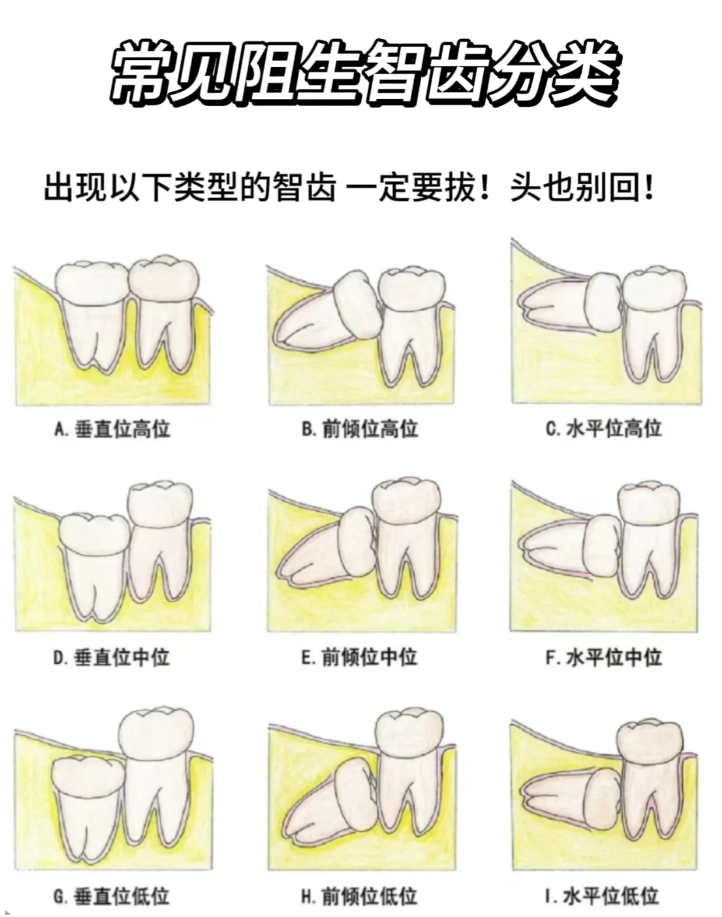 智齿的正确生长方式图图片