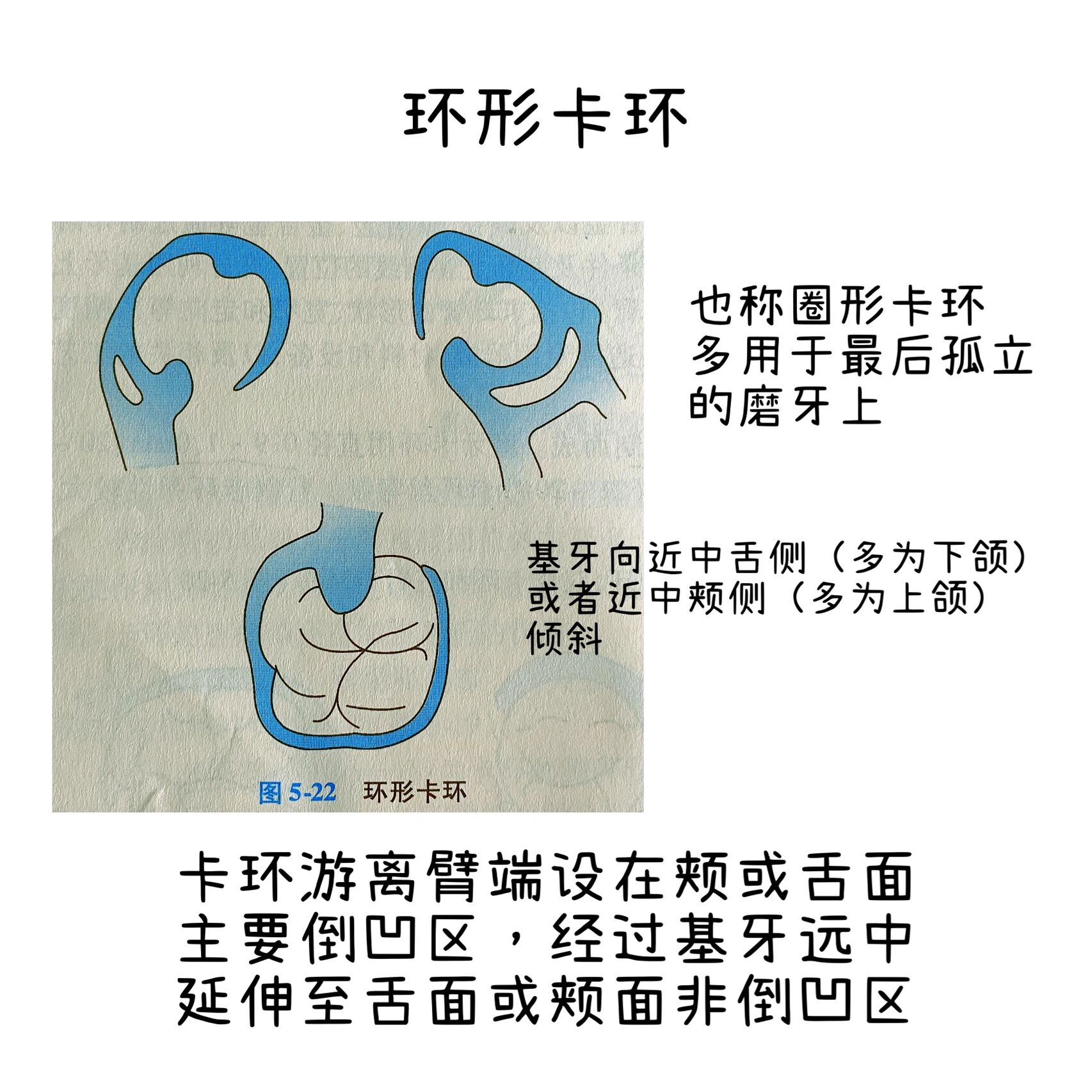 卡环的种类及其用法