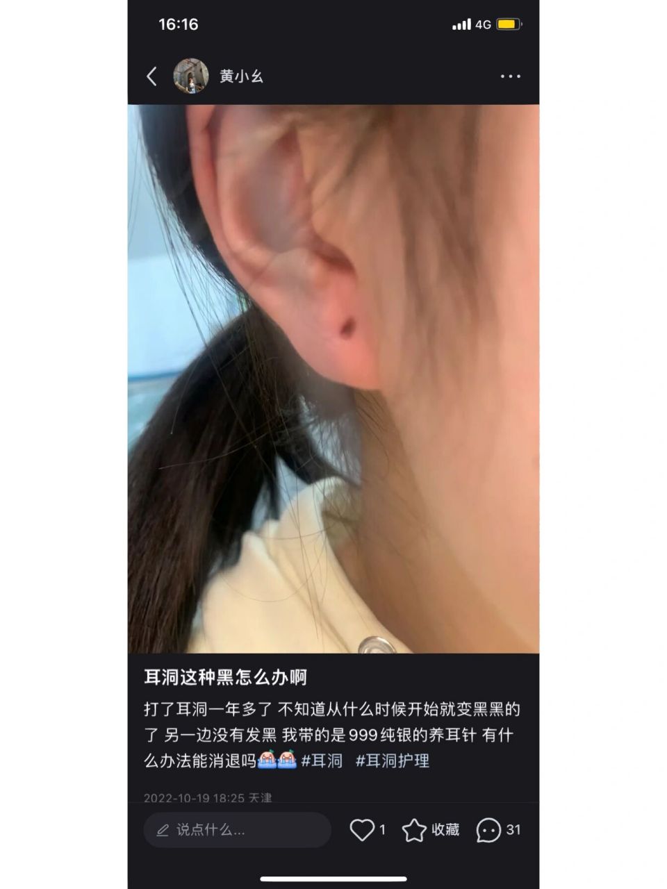 耳洞发黑解决办法 之前耳洞一直黑黑的 看了很多小红书之后我就入手了