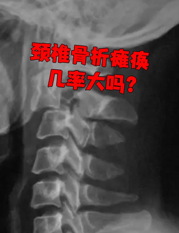 颈椎骨折确实比其他部位的骨折更容易导致瘫痪