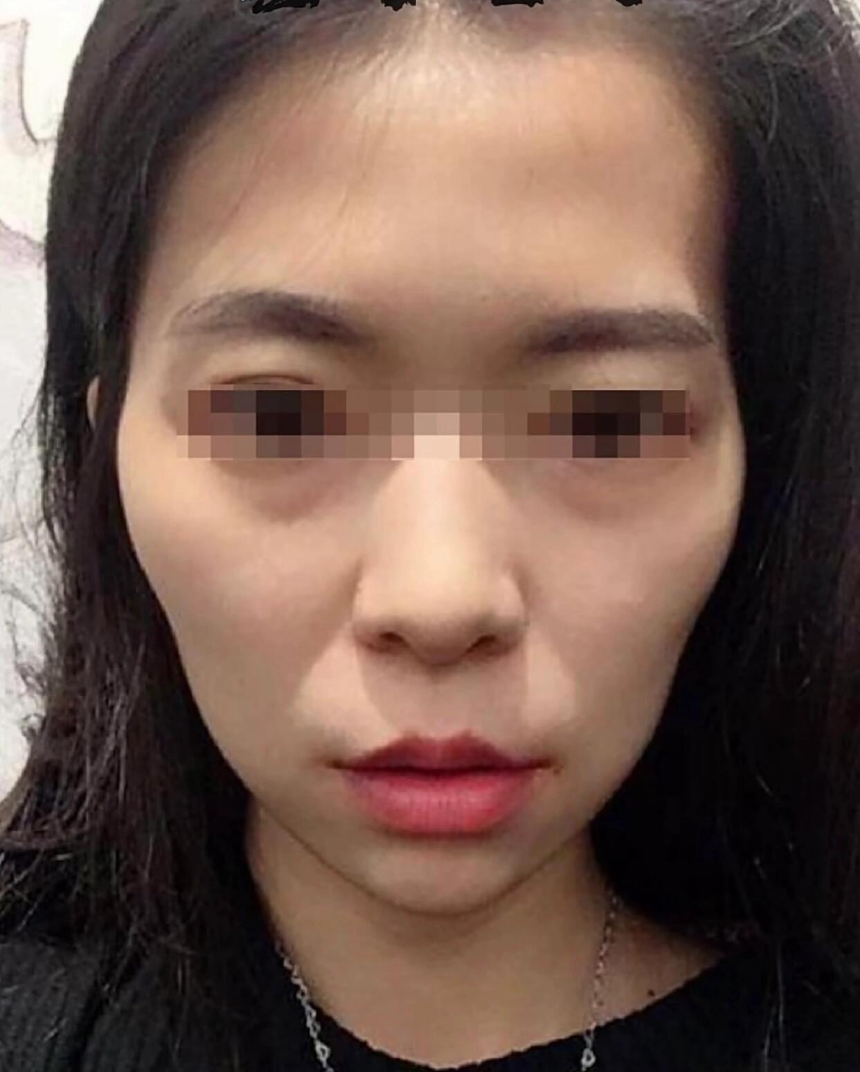 面颊凹陷 白老师面部抗衰手法之科普篇 面颊凹陷是缺肉了吗?