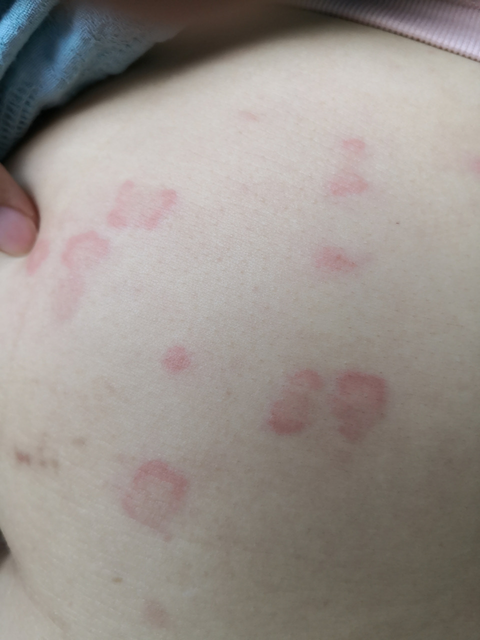 考虑荨麻疹症状#解决皮肤问题专注皮肤美容# 排查一下药物过敏导致的