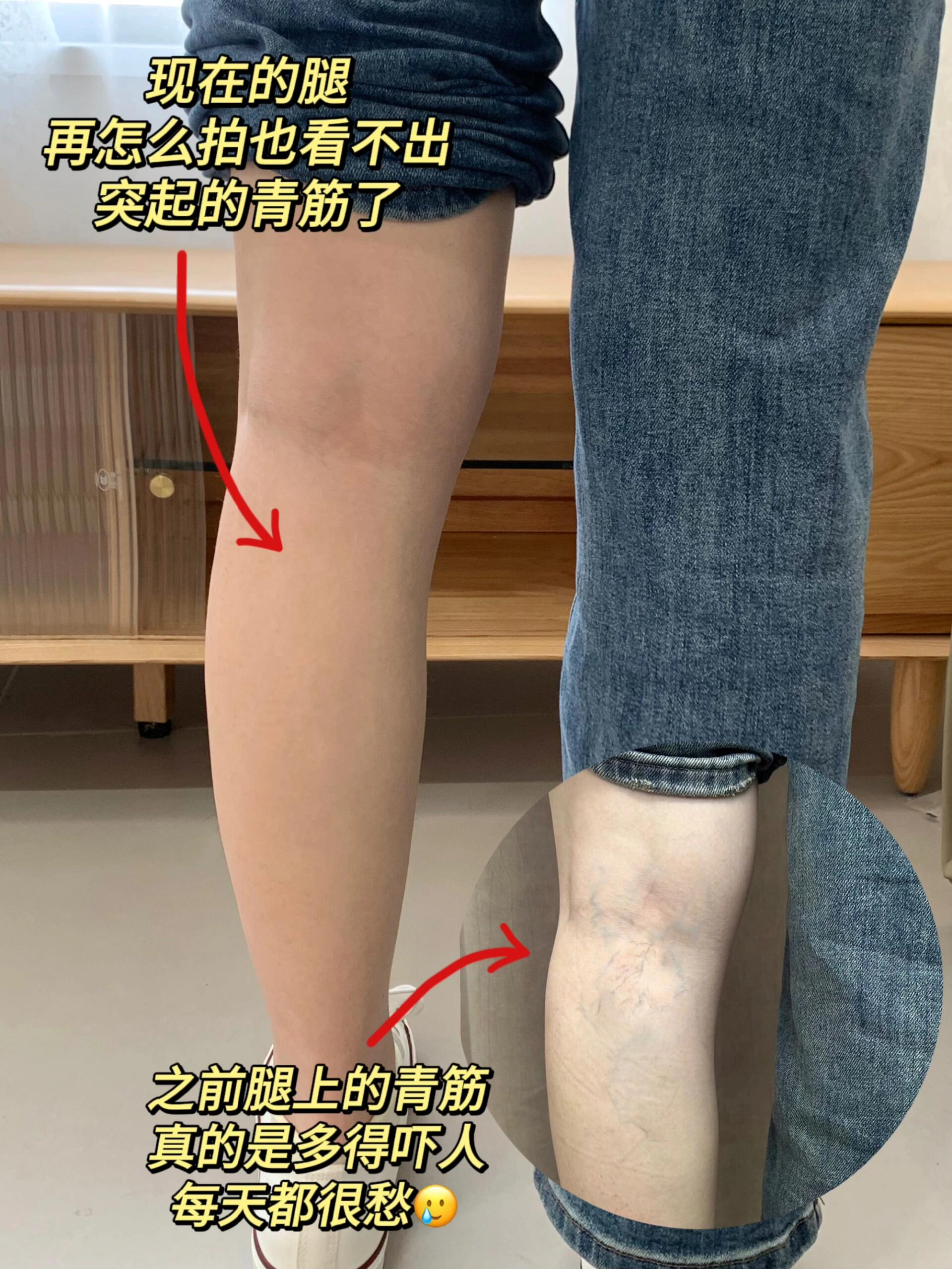 终于摆脱蚯蚓腿了!