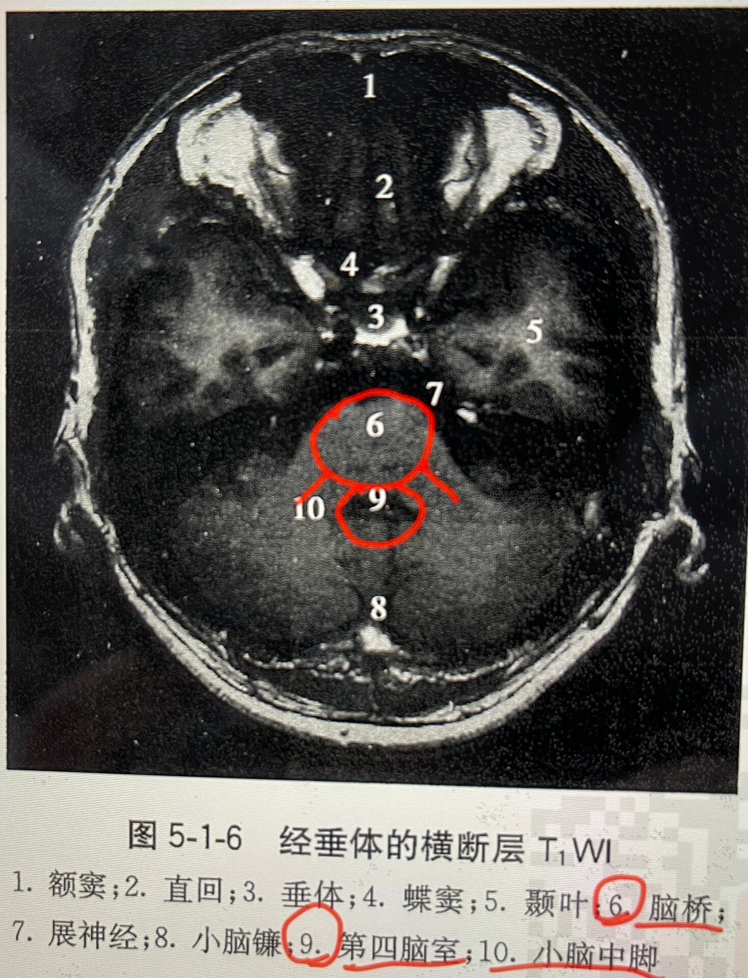 海绵窦血栓图片