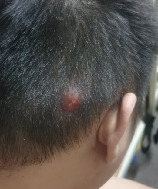 头上起包一按就疼,常见原因有外伤,毛囊炎或皮脂腺囊肿