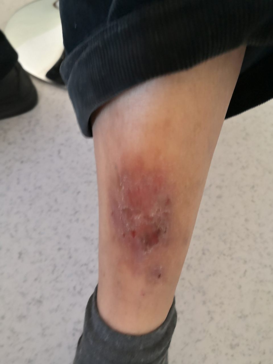 小腿胫前的湿疹症状.#湿疹##淤积性皮炎