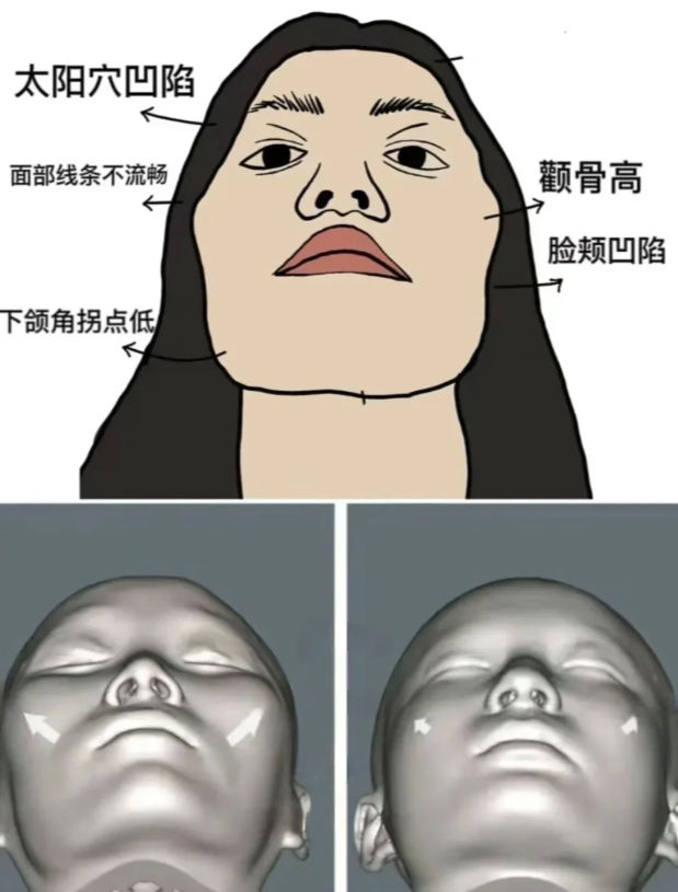 太阳穴凹陷,面颊凹陷,鼻基底凹陷,颧骨突出,法令纹又深,我真的是thank