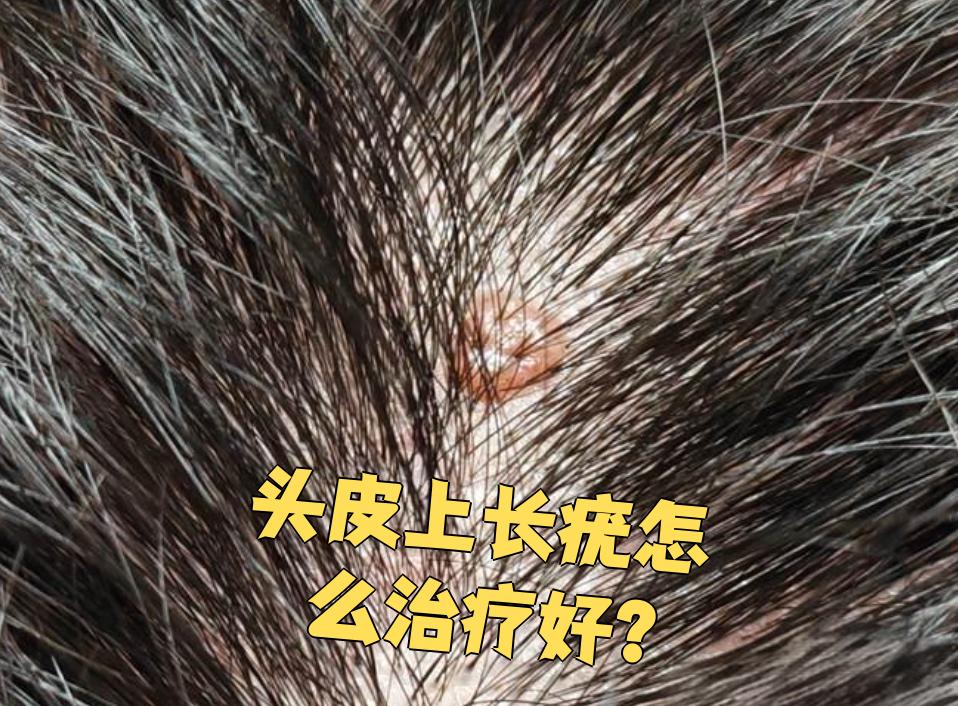 头皮上长疣可以这样治疗: