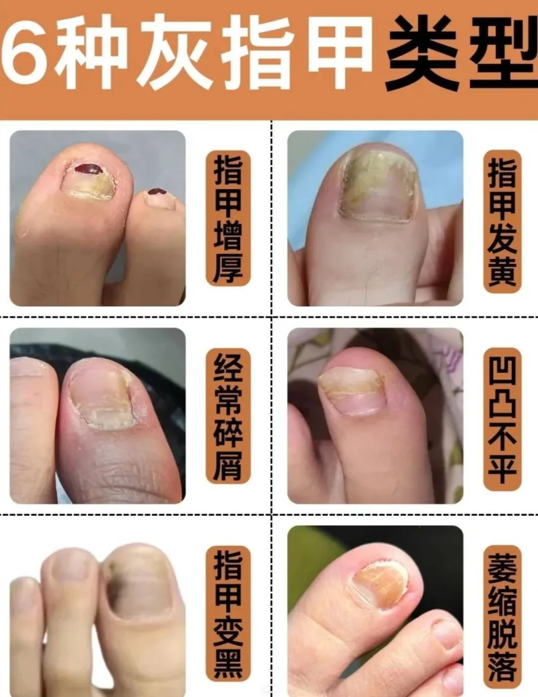 脚大拇趾甲一半发白变空,常见原因有甲癣,甲剥离,外伤和甲营养不良