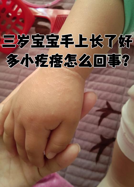 三岁宝宝手上长了好多小疙瘩怎么回事?
