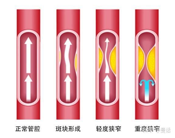 怎么看颈动脉彩超报告