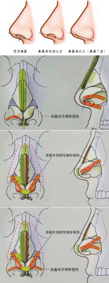 什么是鼻翼缘退缩 鼻翼缘在鼻翼的两侧