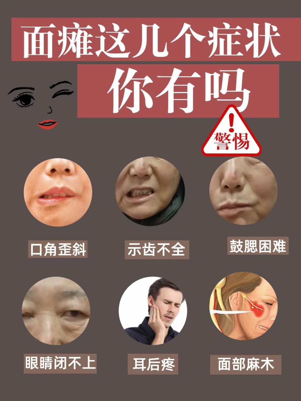 面瘫这些症状你有吗?