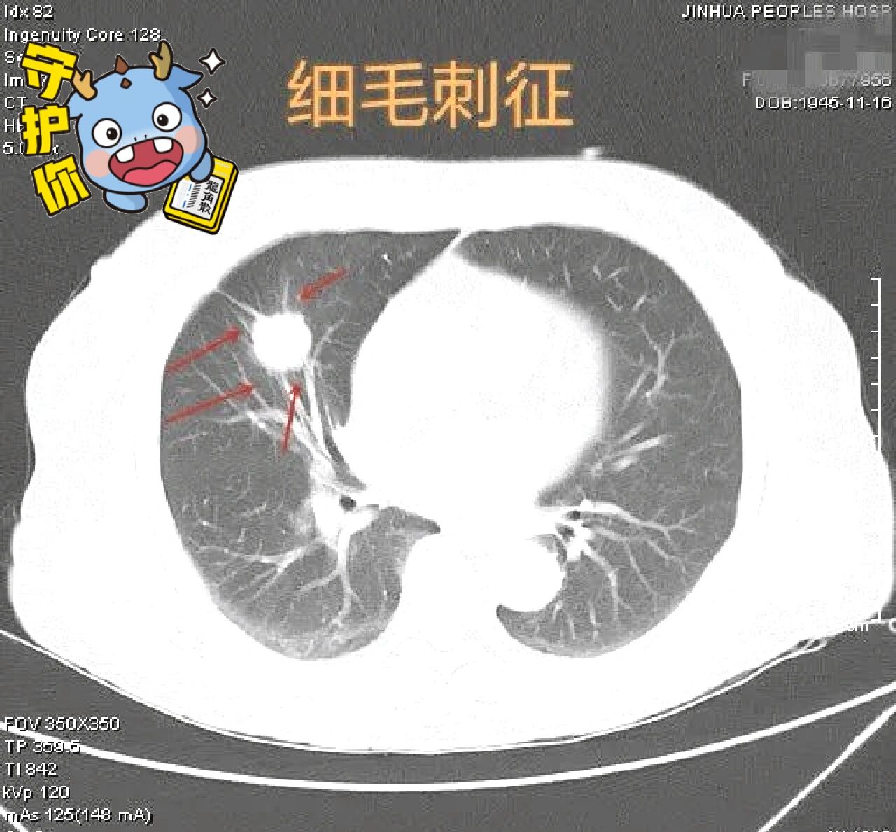 肺部有毛刺是指肺部孤立结节或者肿块