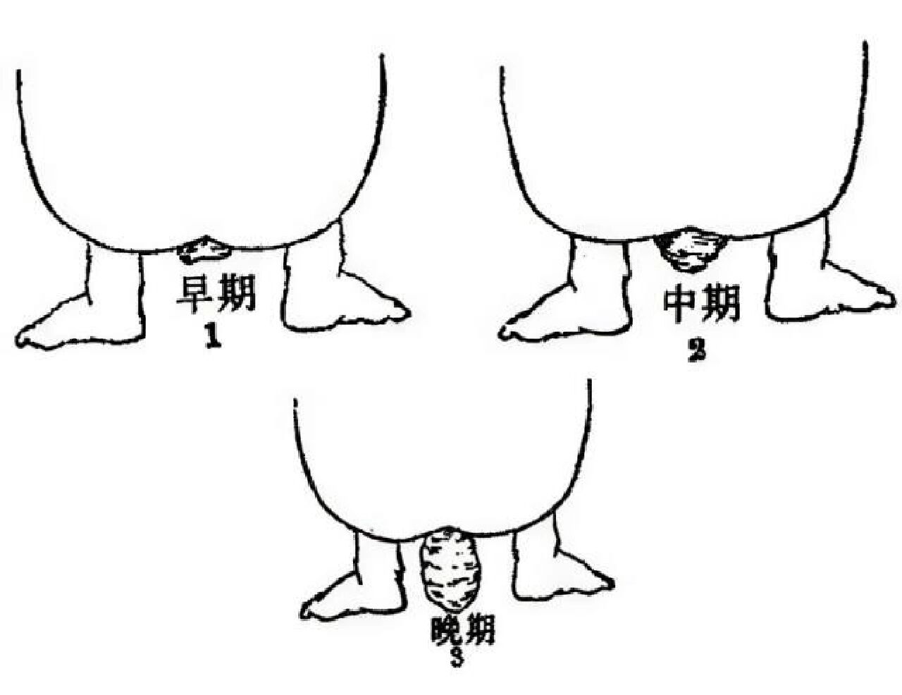 脱肛了怎么办图片