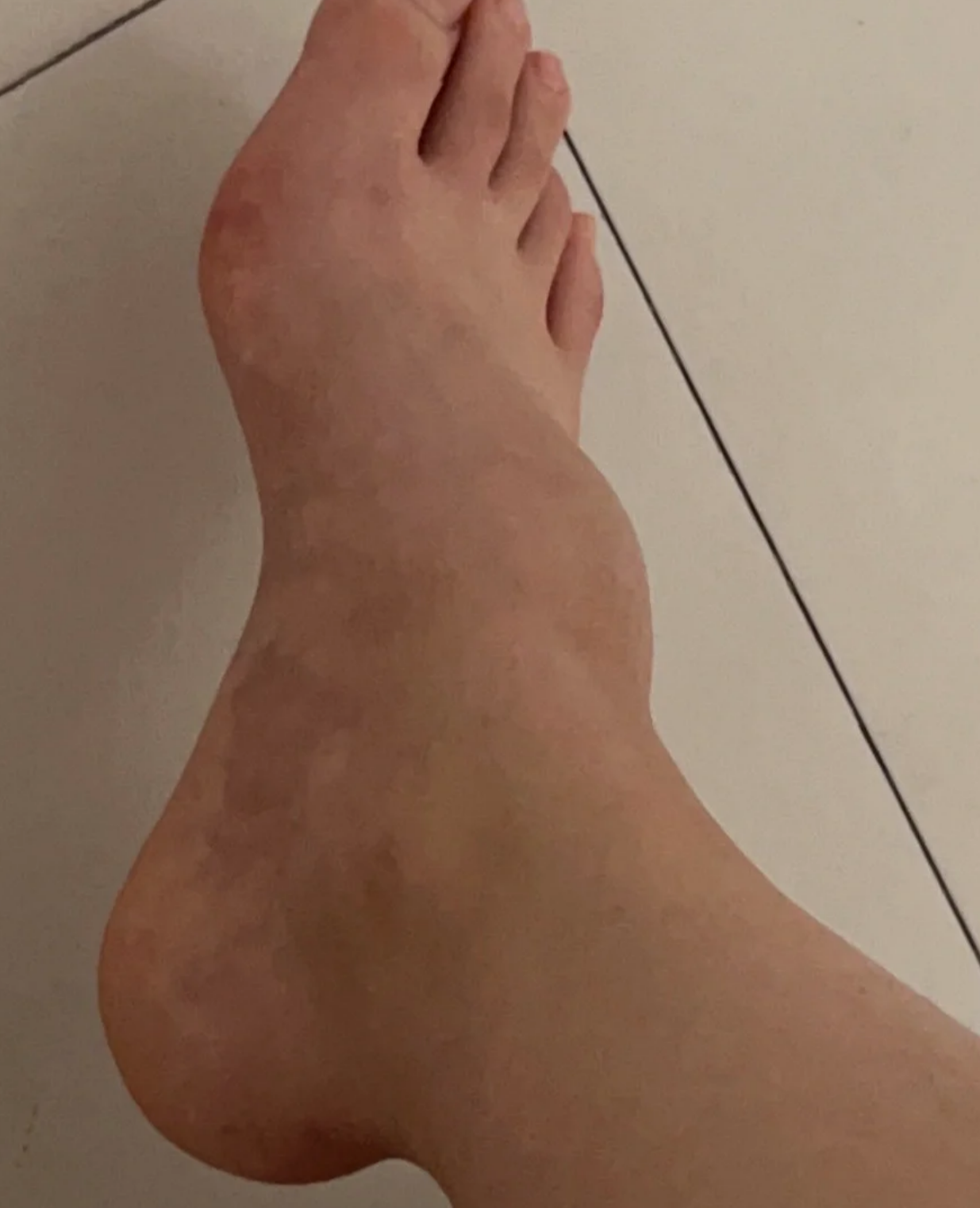 跖骨骨折后脚背一直肿是不正常的