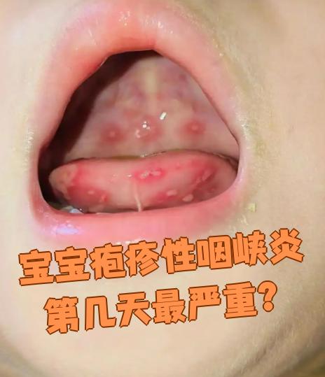 疱疹性咽峡炎通常在发病后第3