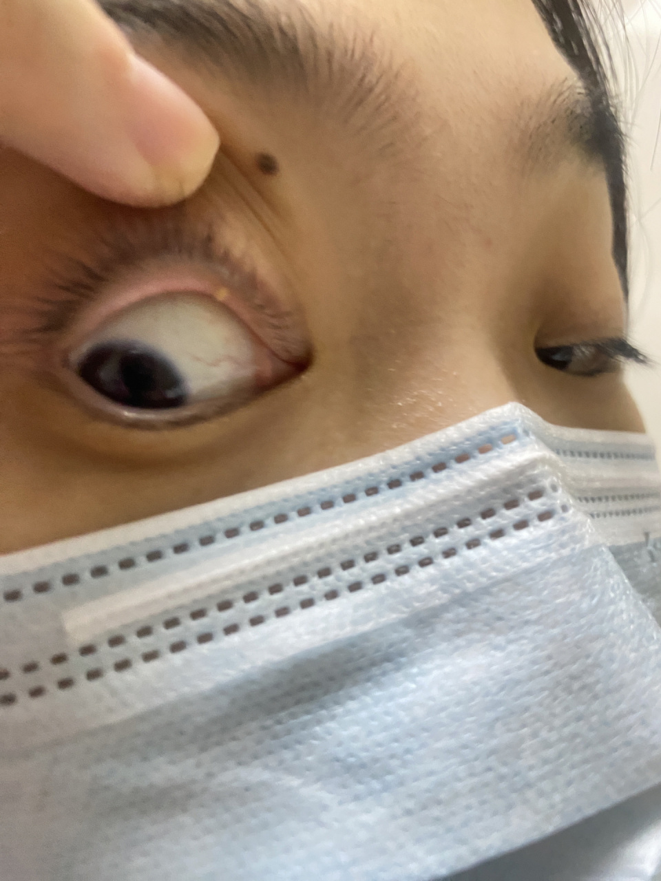 神奇的三天后吸收了!还好管住手没有去挑破