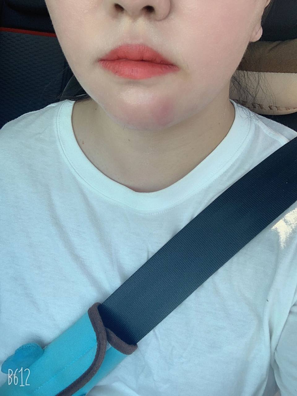 我的下巴一夜之间长了个大火包,又硬又疼