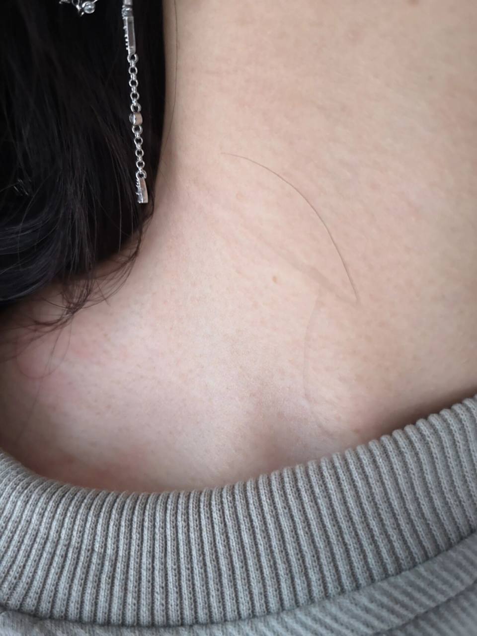 脖子上这样是黑棘皮吗 从小就是这样  是不是代谢不太好啊