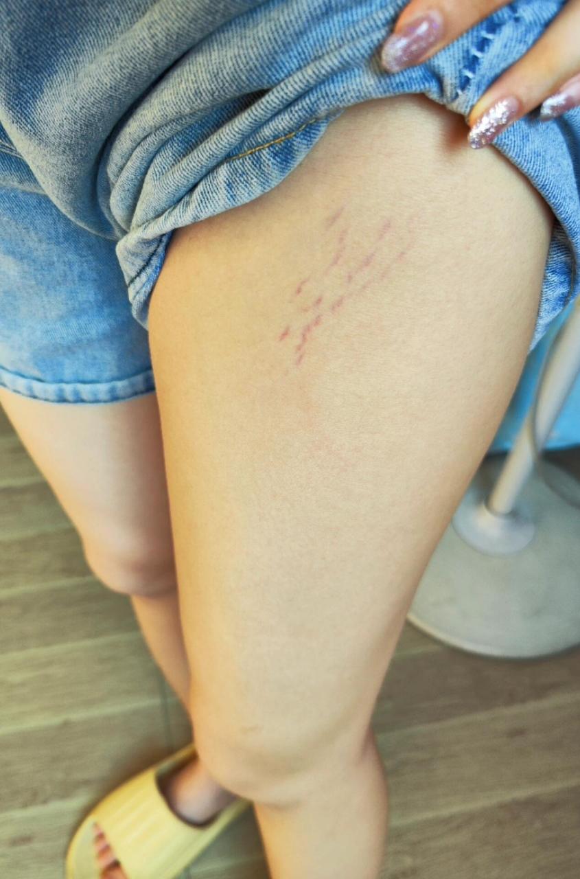 腿上有肥胖纹姐妹都去用!最直接的变化就是肉眼看着纹路变透了,用