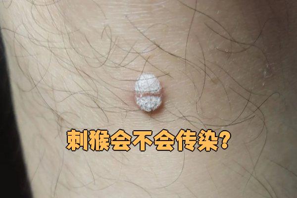 刺猴是由hpv病毒感染引起的皮肤病,俗称瘊子,医学上叫寻常疣或疣