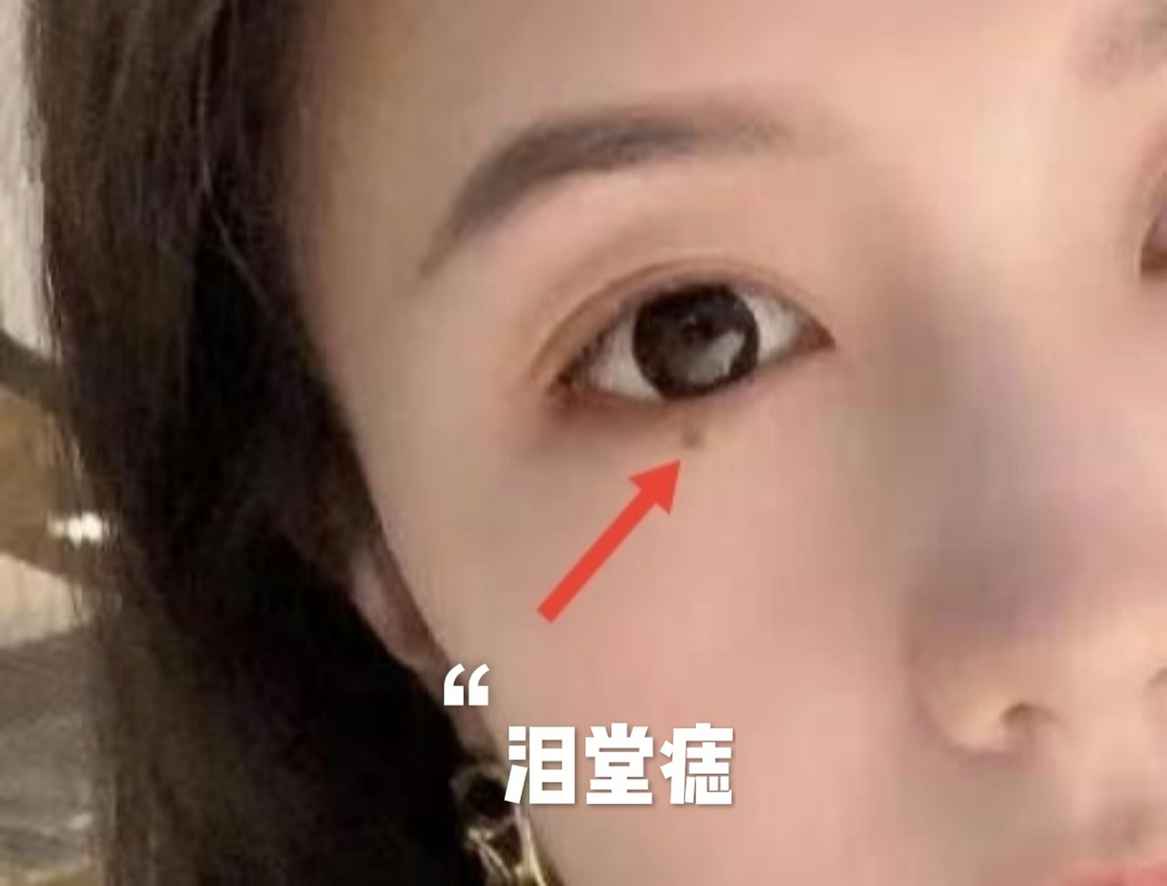 面相之(泪堂痣) 【泪堂痣】 眼袋卧蚕泪堂长痣,相称泪堂痣,主忧子.