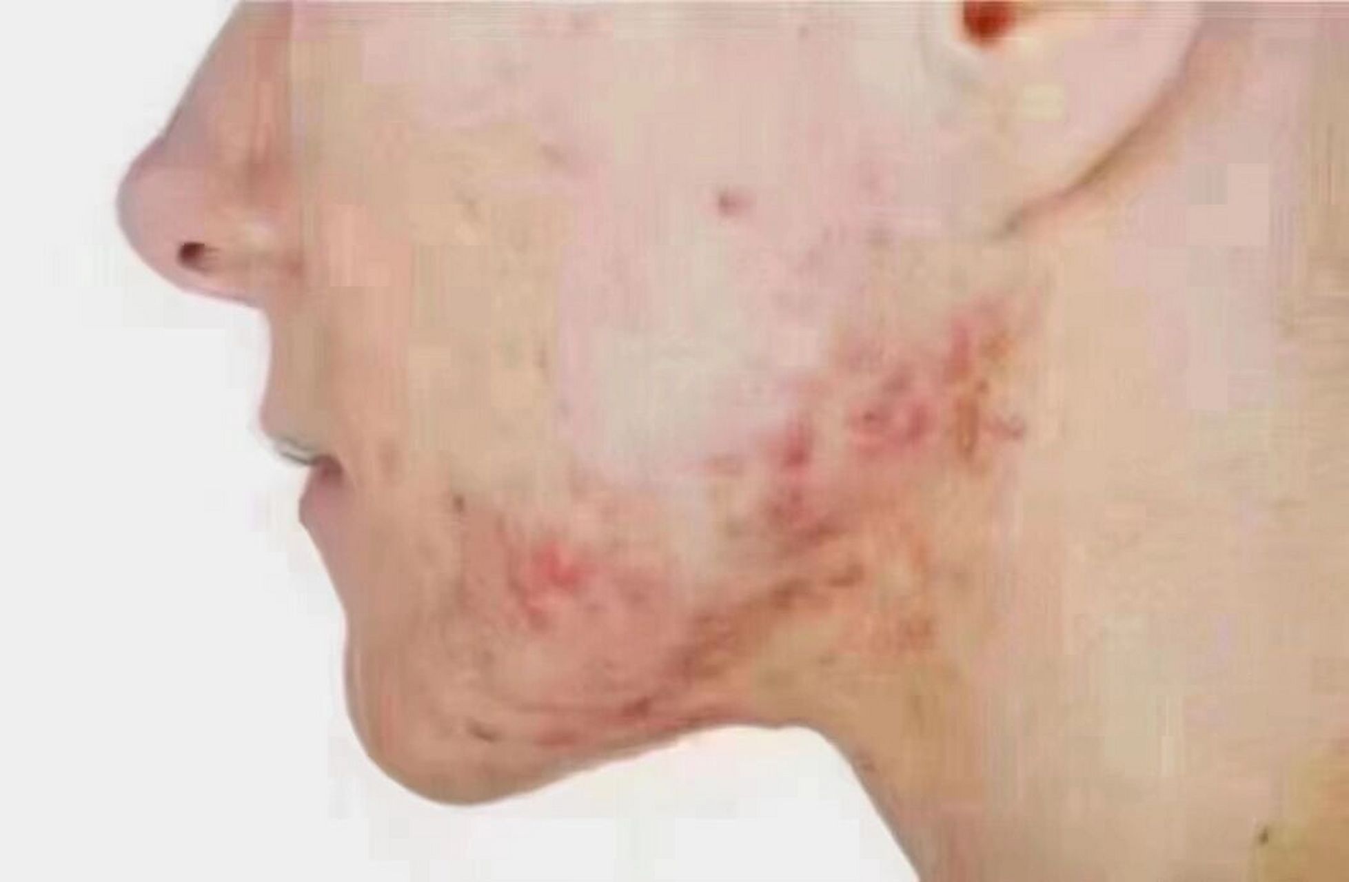 腮边痘的原因: 腮边痘主要是长期肝胆超负荷,淋巴排毒不畅引起,主要在